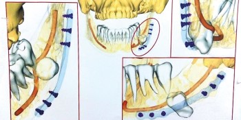 ZOOM CLINIQUE N°10 : La chirurgie orale guidée en cas de dents de sagesse difficiles